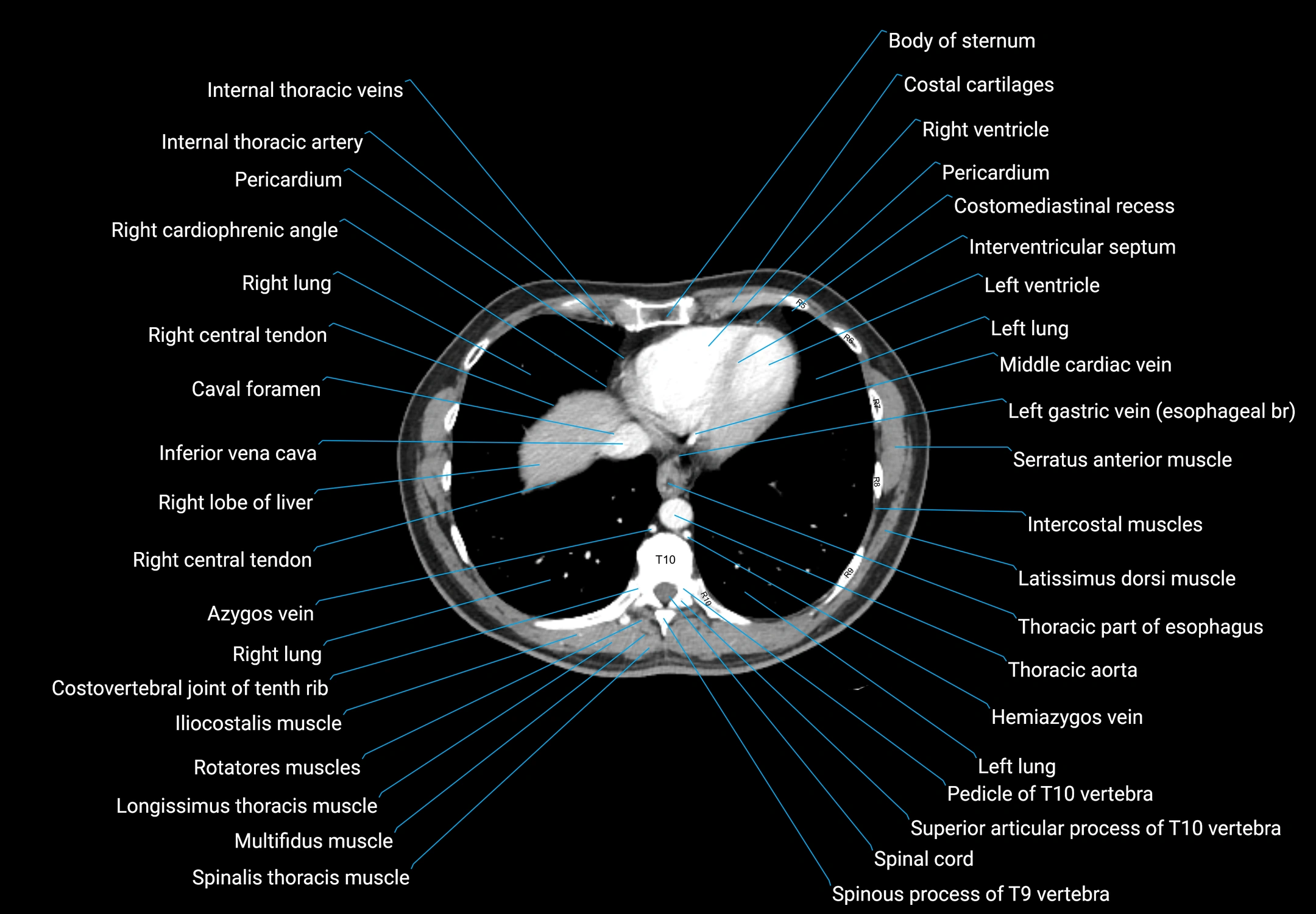 CT male pelvis axial cross sectional anatomy labelled radiology image -00010.webp